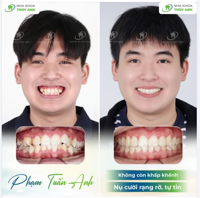 NIỀNG RĂNG SẮP XẾP LẠI RĂNG KHẤP KHỂNH NẶNG, CƯỜI HỞ LỢI
