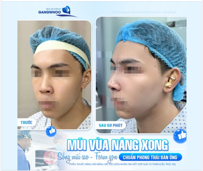 FLEX NHẸ DÁNG MŨI VỪA NÂNG XONG