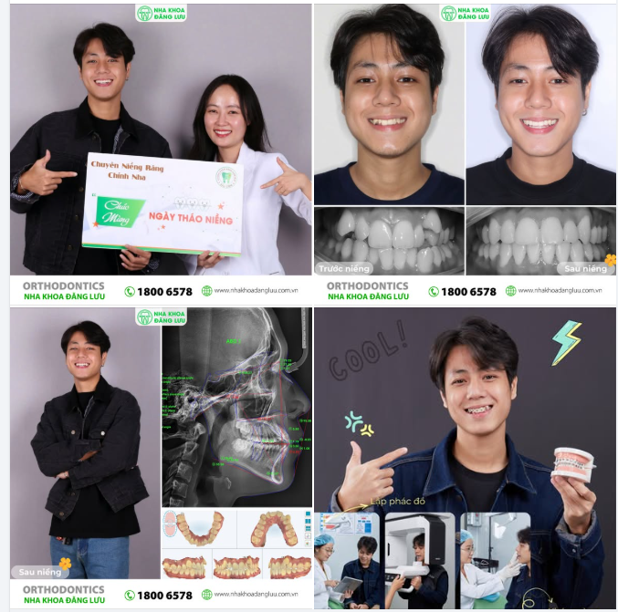 ANH TRAI Phúc Mạnh SAY SMILE TRONG NGÀY THÁO NIỀNG TẠI NHA KHOA ĐĂNG LƯU