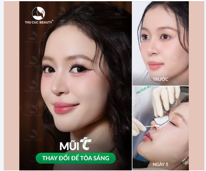 HH Kiều Duy chọn Mũi TC để hoàn thiện ngoại hình