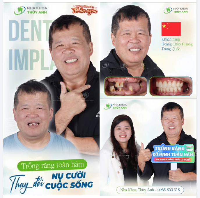 PHÁC ĐỒ TOÀN DIỆN PHỤC HỒI HÀM RĂNG CHO CHÚ KHÁCH HÀNG TRUNG QUỐC