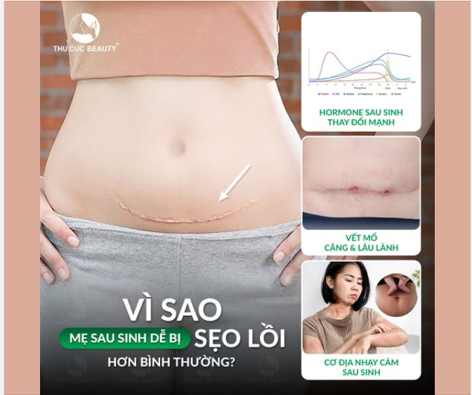 Vì sao mẹ sau sinh dễ bị SẸO LỒI hơn bình thường?