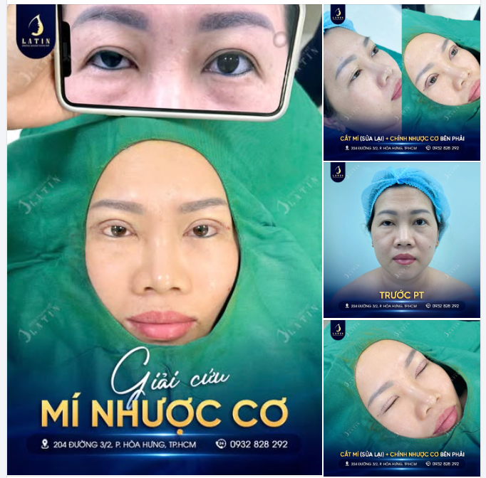 GIẢI CỨU MÍ NHƯỢC CƠ - ĐÃ CẮT NHƯNG BỊ HỎNG