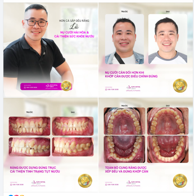 HƠN CẢ SẮP ĐỀU RĂNG – LÀ NỤ CƯỜI HÀI HÒA VÀ CẢI THIỆN SỨC KHỎE NƯỚU