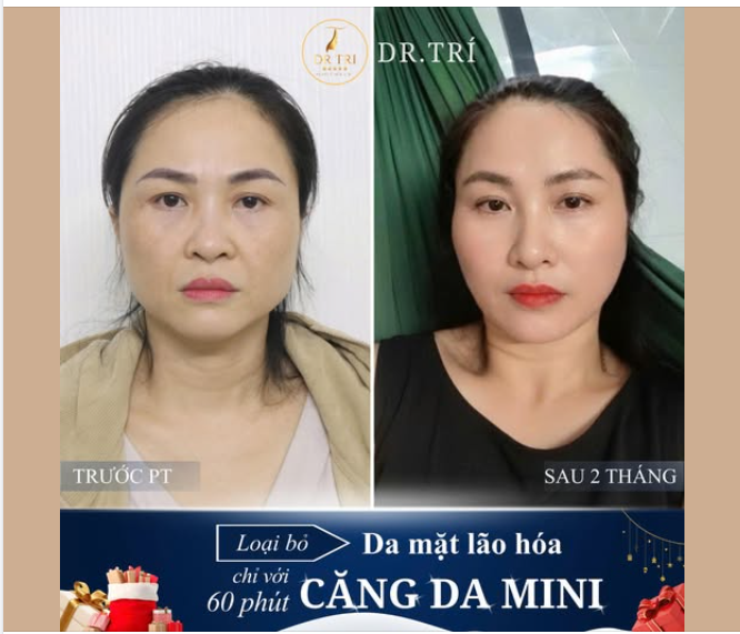 CĂNG DA MINI 60 PHÚT: LOẠI BỎ LÃO HÓA – TRẺ HÓA SAU 2 THÁNG!