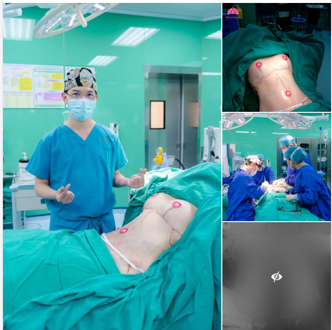 Combo treo sa trễ Hút mỡ tạo hình thành bụng tại Thẩm mỹ Bệnh viện Hồng Ngọc