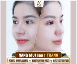 Sau 1 tháng:  Mũi đẹp dáng – mắt sáng tự nhiên  Nàng bảo giờ lên hình không cần chỉnh