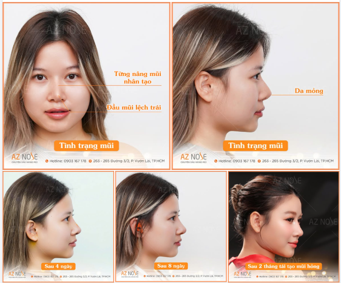 Gương mặt mất cân đối vì mũi lệch sau nâng? Đừng để tình trạng này kéo dài.