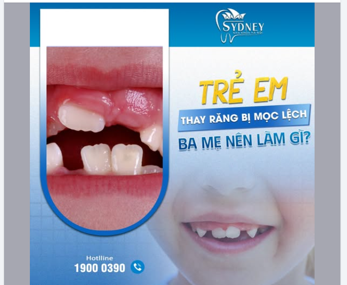 TRẺ THAY RĂNG BỊ MỌC LỆCH - BA MẸ NÊN LÀM GÌ?