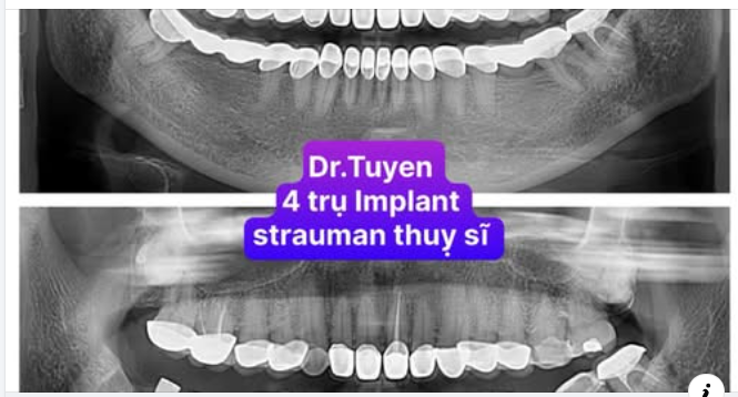 Tuổi Thọ Của Implant Răng: Những Điều Bạn Cần Biết