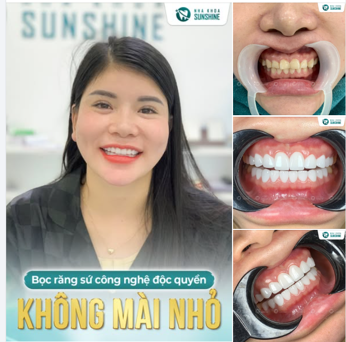 BỌC RĂNG SỨ MÀ KHÔNG MÀI NHỎ RĂNG? ​​​​​​​Bí quyết nụ cười đẹp không tổn hại răng thật!