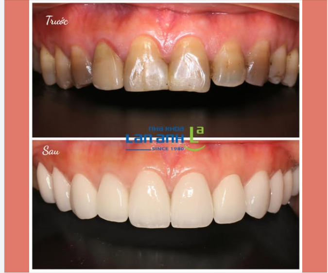 Răng sứ tại nha khoa Lan Anh luôn đạt kết quả cao nhất có thể, độ chính xác rất tốt và kết quả là răng sứ dùng được rất lâu dài ạ