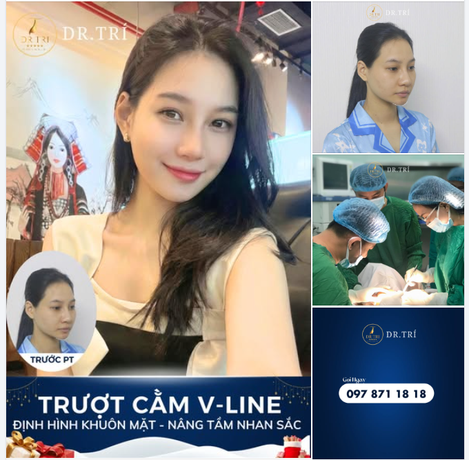 TRƯỢT CẰM V-LINE: ĐỊNH HÌNH KHUÔN MẶT – NÂNG TẦM NHAN SẮC TỨC THÌ!