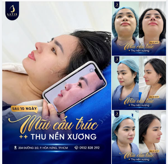 MŨI CẤU TRÚC – THU NỀN XƯƠNG SAU 10 NGÀY  CHỊ KHÁCH “ĐỨNG HÌNH 5 GIÂY” KHI NHÌN MÌNH TRONG GƯƠNG