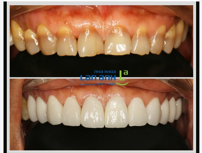 Nụ cười mới với răng sứ đẹp mỹ mãn