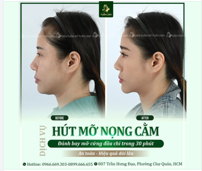 HÚT MỠ NỌNG CẰM – THON GỌN, CHUẨN VLINE CHỈ TRONG 30 PHÚT