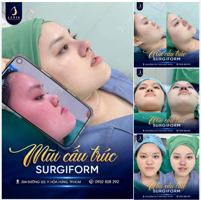 NÂNG MŨI CẤU TRÚC SURGIFORM – THAY ĐỔI NHẸ, HÀI HÒA CẢ GƯƠNG MẶT
