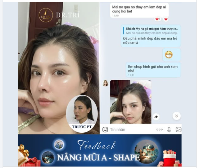 MŨI HẾCH, TẸT, CO RÚT? NÂNG MŨI A-SHAPE – CAM KẾT LÀM LÀ ĐẸP!