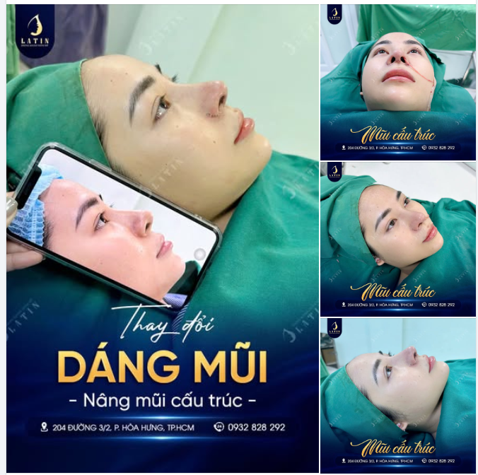 NÂNG CẤP DÁNG MŨI – ĐỔI MỚI TỪ GÓC NGHIÊNG