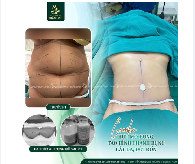 TẠM BIỆT BỤNG MỠ – DA CHẢY XỆ LẤY LẠI EO THON, BỤNG PHẲNG MỊN