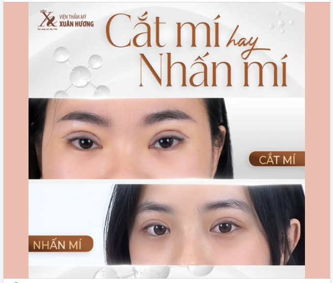 NÊN CHỌN CẮT MÍ HAY NHẤN MÍ?