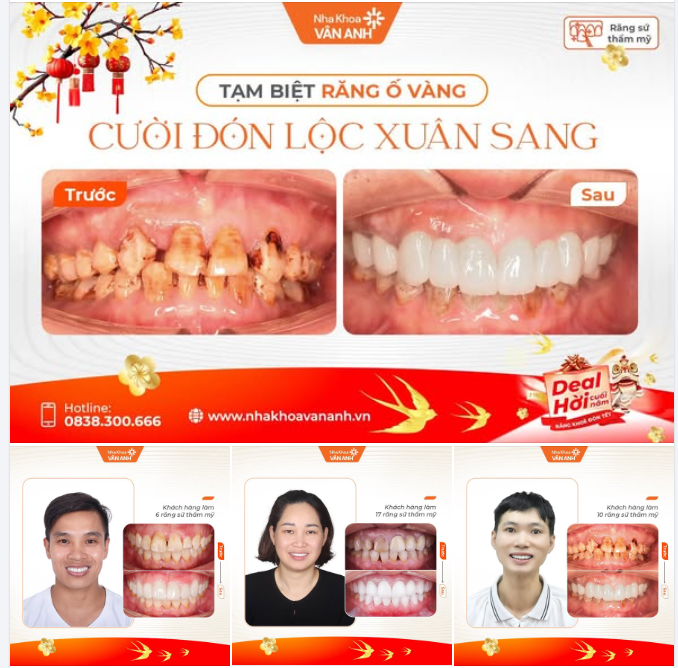 TẠM BIỆT RĂNG Ố VÀNG – CƯỜI ĐÓN LỘC XUÂN SANG