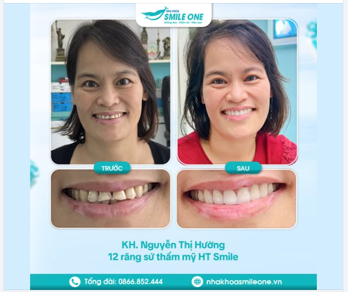 Trẻ ra cả chục tuổi sau khi làm răng sứ