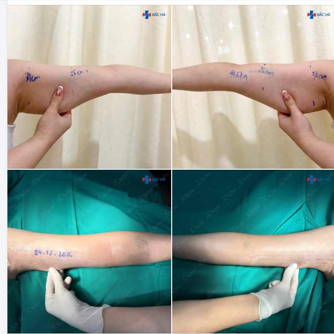 ƯU ĐÃI CUỐI NĂM: HÚT MỠ CÁNH TAY GIẢM 40% – TẶNG LUÔN NÁCH