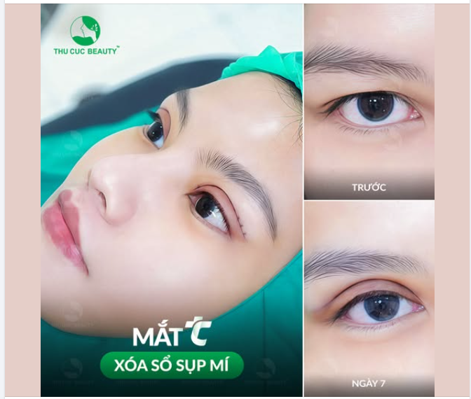 Sụp mí khiến đôi mắt kém sắc   Mắt TC - Định hình nếp mí cân đối, sắc nét