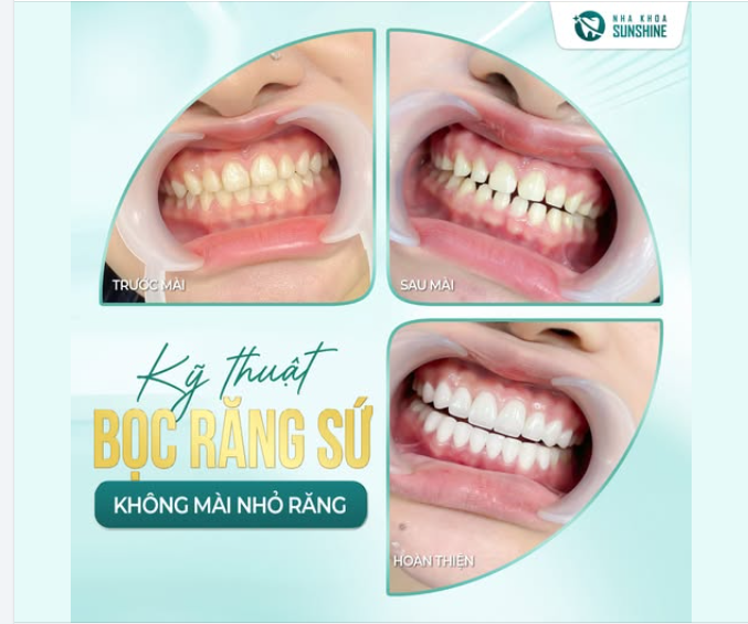 “THỜI NÀO RỒI CÒN NGHĨ BỌC RĂNG SỨ BỊ MÀI NHỎ RĂNG”