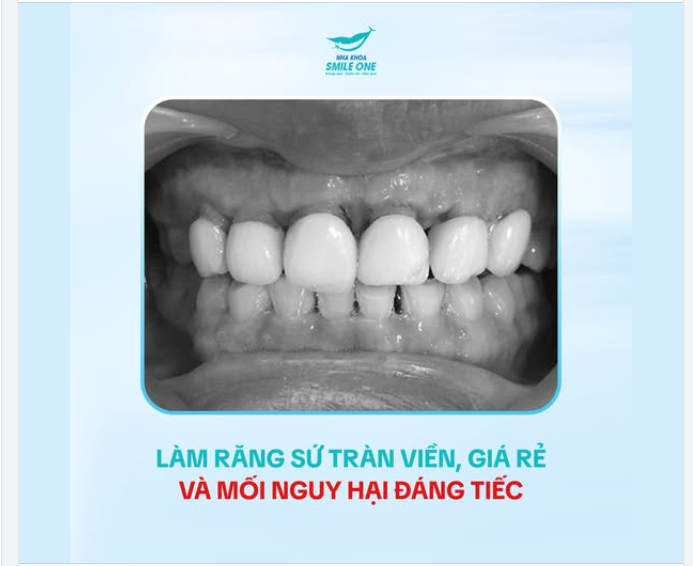 Việc làm răng sứ bị "tràn viền" (hay còn gọi là đường hoàn tất không đúng kỹ thuật, xâm phạm khoảng sinh học)