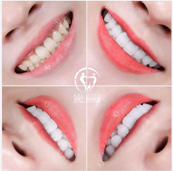 TẾT SẮP ĐẾN RỒI – NỤ CƯỜI CỦA BẠN ĐÃ SẴN SÀNG TỎA SÁNG?