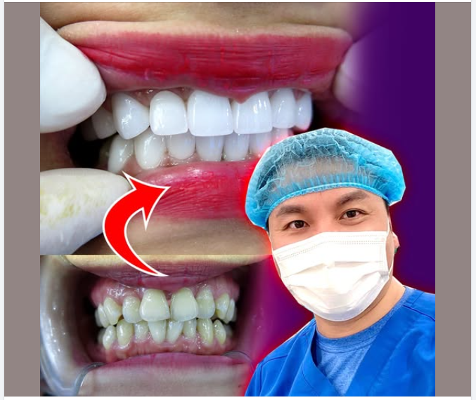 khiếm khuyết nụ cười mà bạn nên cải thiện