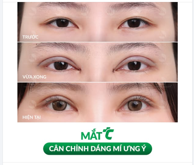 Quá trình hồi phục sau cắt mí siêu ưng ý tại Thu Cúc: