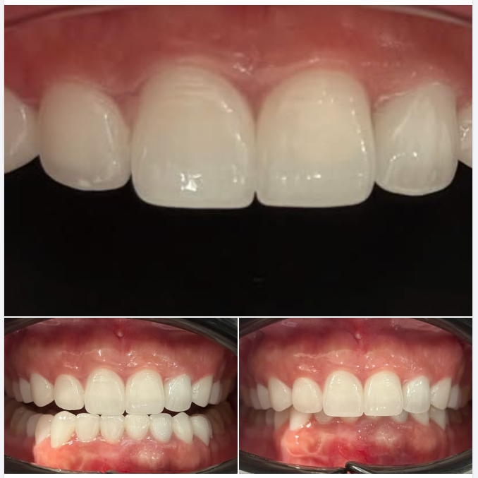 Bọc răng sứ giữ được bao lâu?