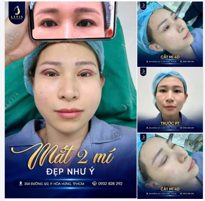 CẮT MÍ 4D: "TẠM BIỆT" MẮT SỤP – KIẾN TẠO MÍ ĐẸP TỨC THÌ