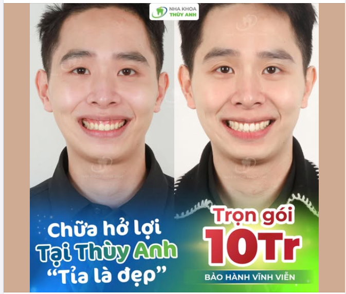 XOÁ CƯỜI HỞ LỢI, NÂNG TẦM NỤ CƯỜI CHUẨN ĐẸP