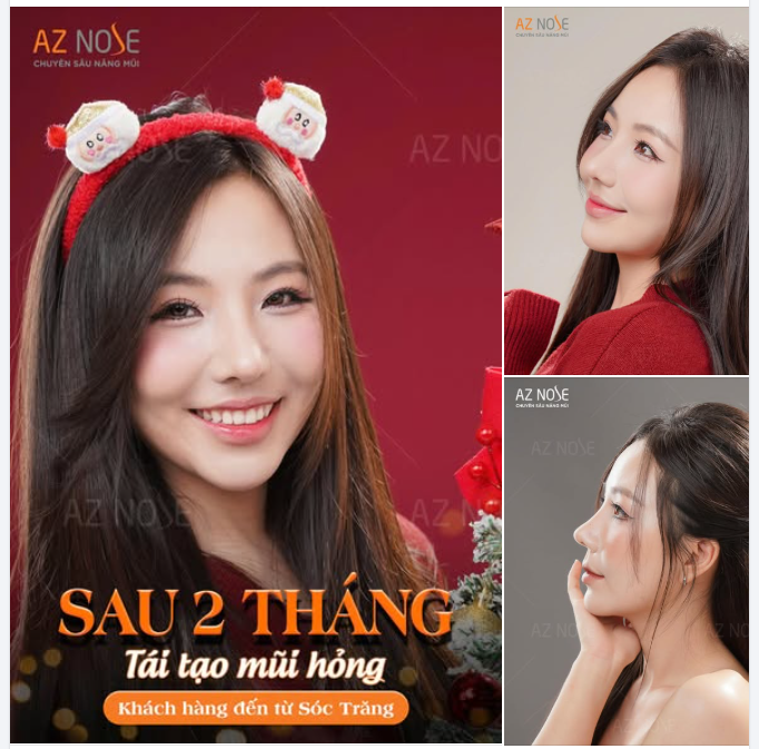 Rạng rỡ đón Giáng sinh với dáng mũi sau 2 tháng