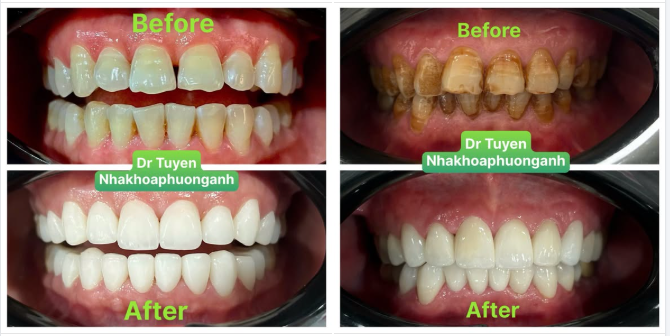 Những khiếm khuyết nụ cười mà bạn nên cải thiện