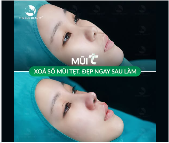 Mũi thấp tẹt hóa cao thon, hút trọn ánh nhìn