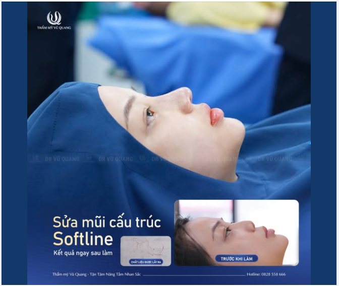 GIẢI CỨU MŨI HỎNG SAU NÂNG MŨI BẰNG CHỈ 1 NĂM