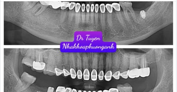 Hướng dẫn chăm sóc răng sau cấy implant