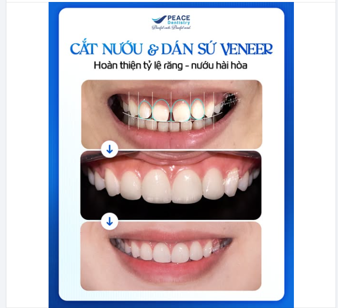 TẾT NÀY, BẠN ĐÃ SẴN SÀNG CHO NỤ CƯỜI MỚI TỰ TIN HƠN CHƯA?