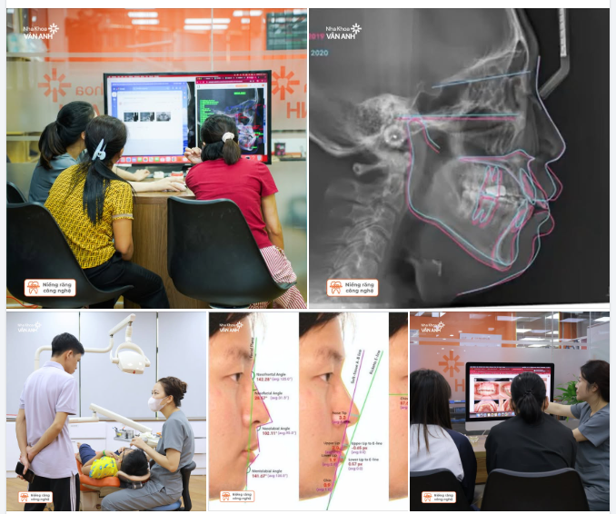 Công nghệ Webceph - Cá nhân hóa phác đồ điều trị niềng răng cho từng khách hàng