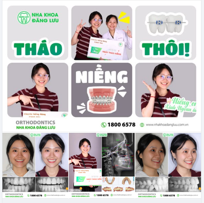 +1 NIỀNG-ER THÁO NIỀNG TRƯỚC TẾT, GỌI TÊN: BẢO NGỌC