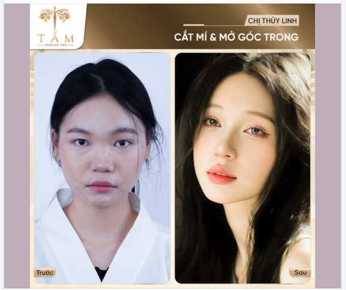 Chị Thuỳ Linh chia sẻ cắt mí mở góc mắt trong