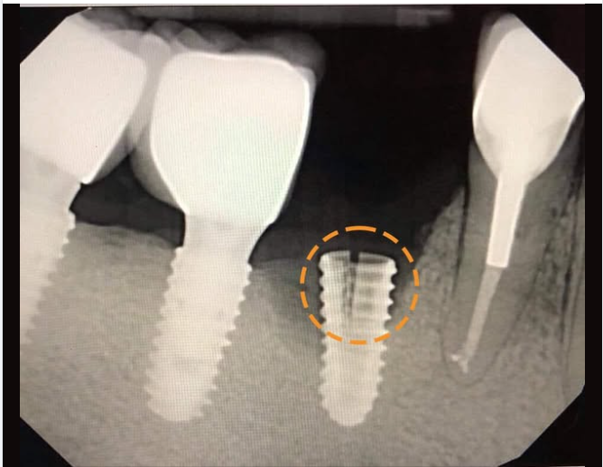 CẢNH BÁO Trồng răng Implant giá rẻ và nguy cơ nhiễm trùng!