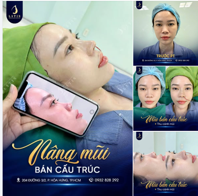CÁNH MŨI GỌN GÀNG - DÁNG MŨI HẠT CHANH
