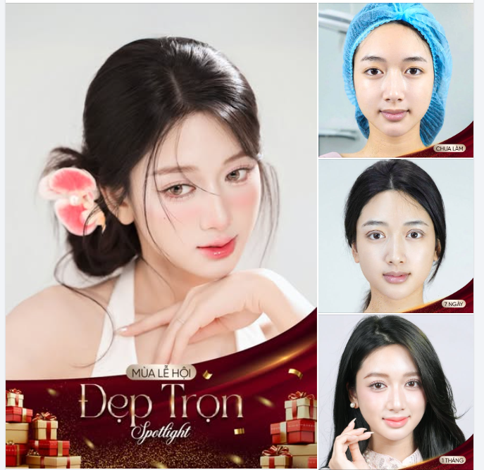 Chị T.H  Dịch vụ: Cắt mí trên + Cấy mỡ