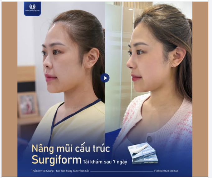 Chỉ 7 ngày sau nâng mũi, dáng mũi cao bay ,mềm mại, tự nhiên, vào form chuẩn đẹp, không lộ dấu vết thẩm mỹ.